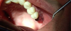 Dental Suture Non Absorbable Polyamide Monamide (PA)