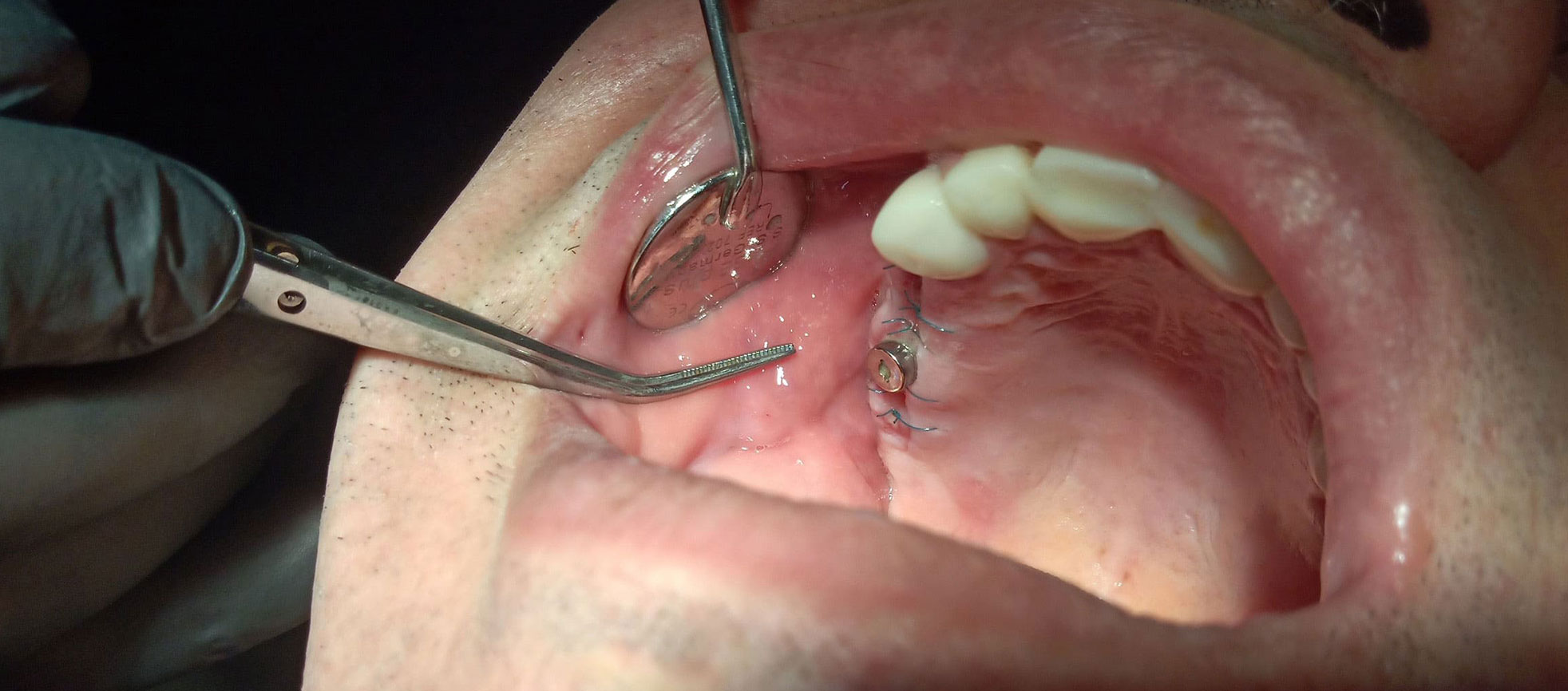 wisdom teeth sutures