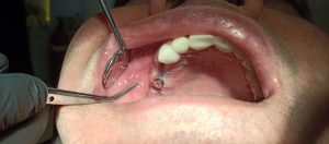 Dental Suture Non Absorbable Polyamide Monamide (PA)